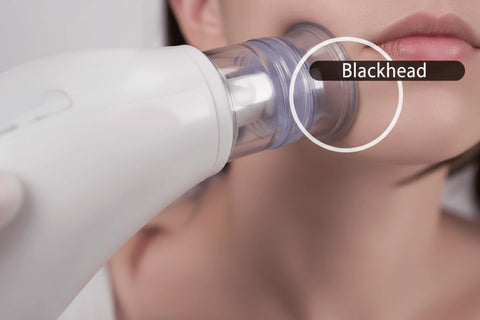 Blackhead Remover Vacuum Results – Clear Skin Pore Cleaner UAE